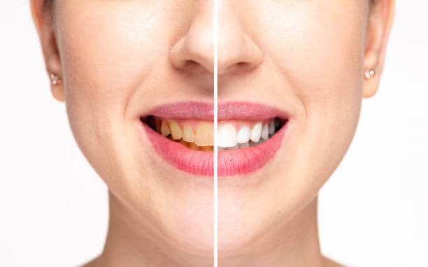 Teeth Whitening Milton Keynes Birmingham