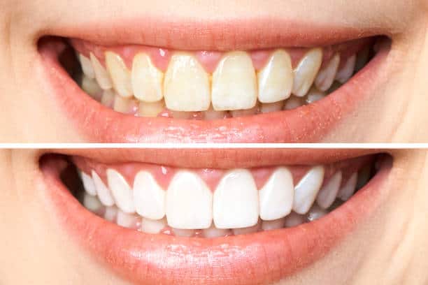 Achieve a Dazzling Smile for Your Special Day: A Guide to Wedding Teeth Whitening Birmingham