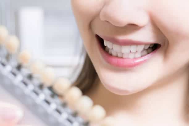 Teeth Whitening Kings Norton Birmingham