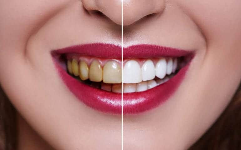 Teeth Whitening Ascot Windsor Birmingham