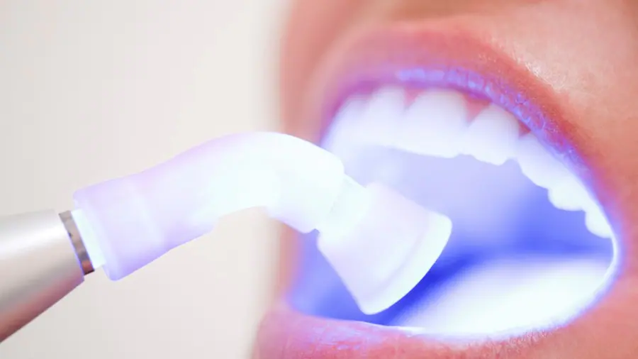 Teeth Whitening Aylesbury Birmingham