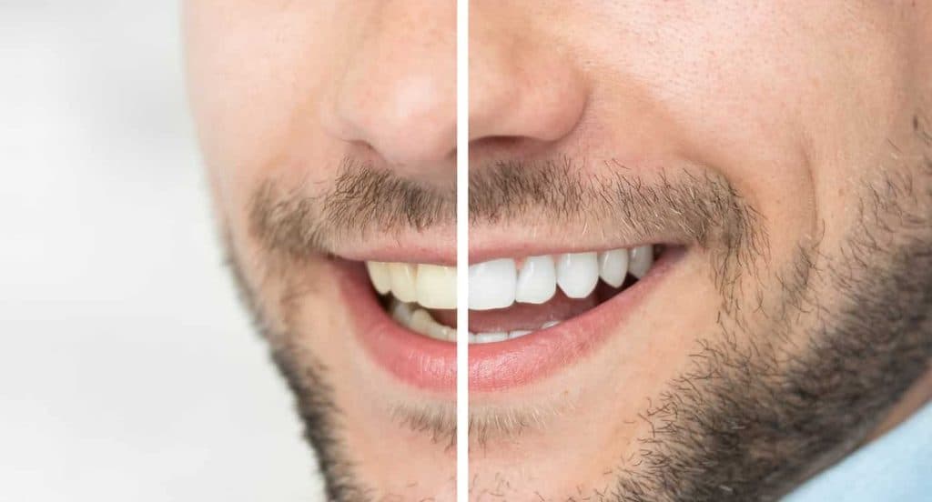 Teeth Whitening Bedfordshire Birmingham